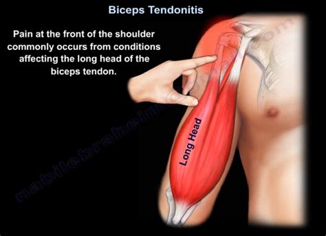 Biceps Tendonitis —