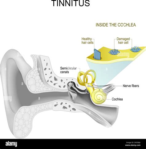 Cochlear Nerve In Ear