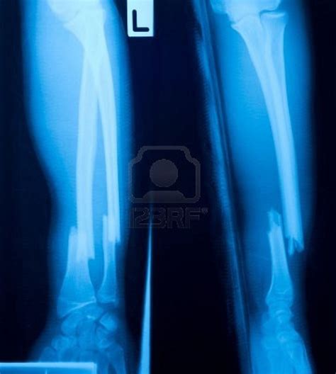 X Ray Film Of Bone Leg Fracture X Ray Ray Film Bone Fracture