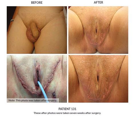 Post Op Vaginoplasty Mega Porn Pics