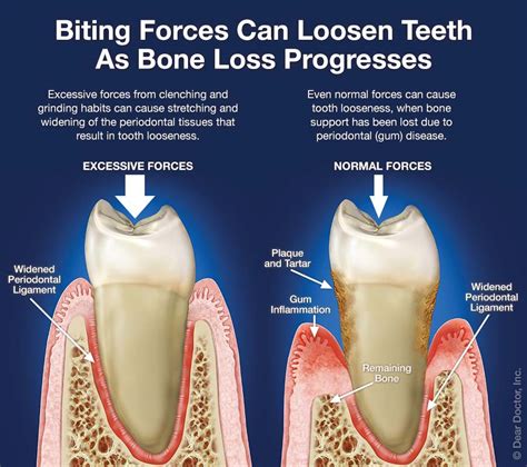 Aside from regular dental hygiene, you can try a next remedies Occlusal therapy: why our bite is important - Britten Perio