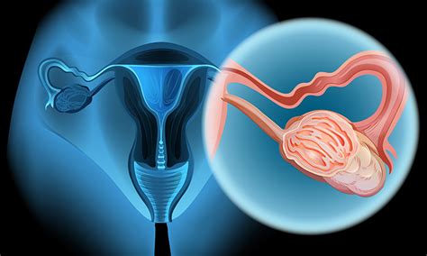 Potential Ovarian Cancer Treatment Proves Effective In Pre Clinical Studies