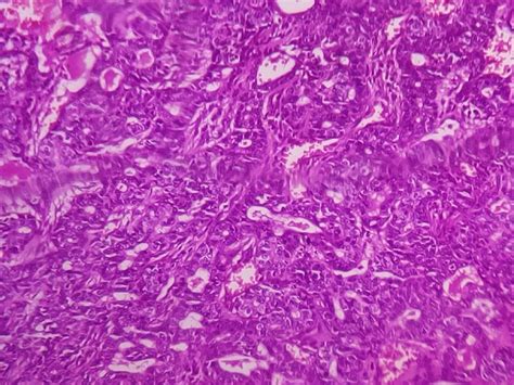 Secretory Carcinoma Of Parotid Gland