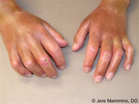 Systemic Sclerosis American Osteopathic College Of Dermatology Aocd