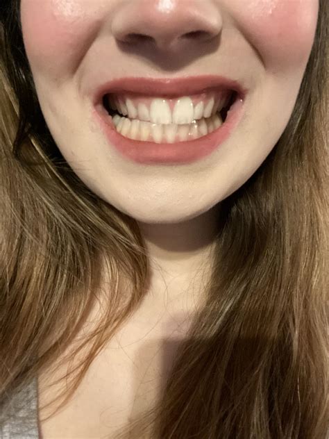 Should I Get Braces I Have A Misaligned Jaw As Seen In The Picture
