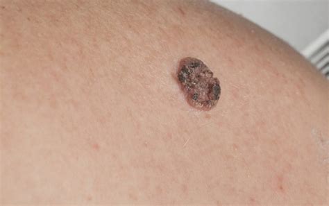 Squamous Cell Carcinoma Skin Cancer Treatment