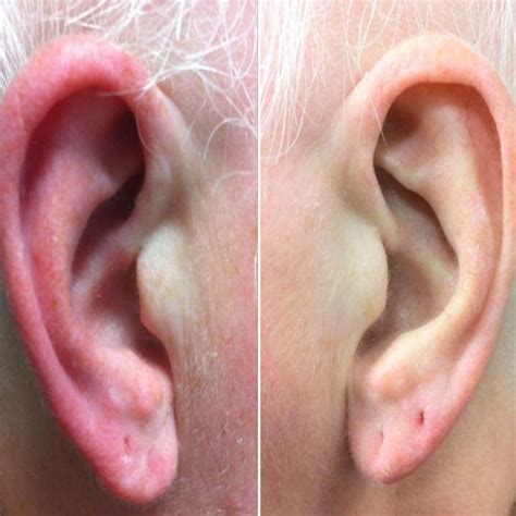 Eczema On Ear How To Get Rid Of Itchy Or Dry Ear Eczema