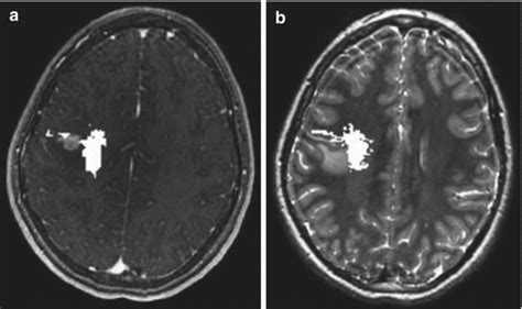 Modern Neuroimaging Of Pediatric Brain Tumors Oncohema Key