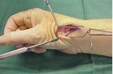 Thumb Arthroplasty Recovery