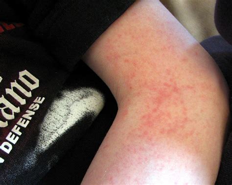 Struggling With An Anxiety Related Rash How To Get Rid Of Stress Hives
