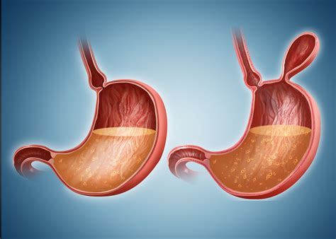 Symptoms often appear once a tumour grows into surrounding tissues and organs. Bowel Obstruction: Symptoms, Causes, Diagnosis, and Treatment