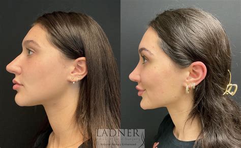 Rhinoplasty Nose Job Before And After Pictures Case 168 Denver Co