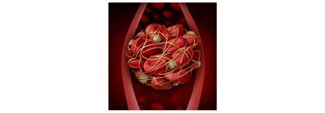 Acquired risk factors for thrombosis. Tres cosas que podemos hacer para prevenir la trombosis ...