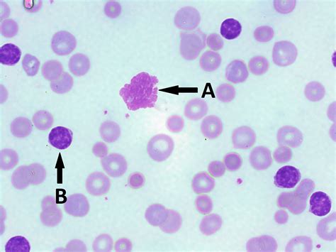 Chronic Lymphocytic Leukemia Cll A Laboratory Guide To Clinical