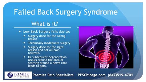 Five Things To Know About Failed Back Surgery Syndrome 847 519 4701
