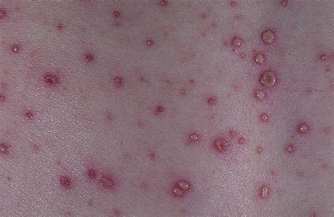 Viral Rash In Adults Pictures Photos