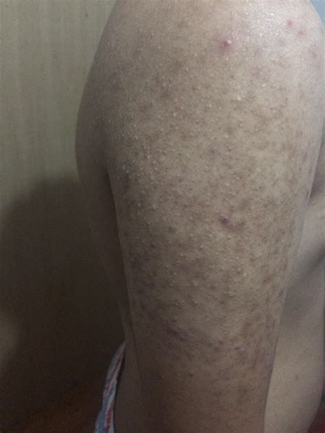 Skin Concern So My Brother Has Been Suffering From This Kind Of Acne