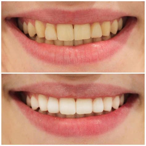Dental Work Before And After Pictures Smiling Dental