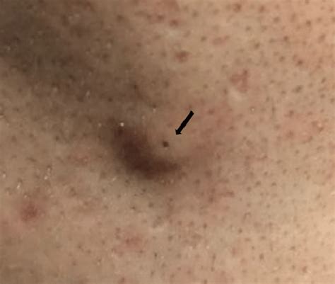 A Photograph Of An Epidermoid Cyst Showing A Round