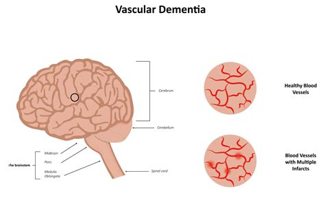 Vascular Dementia The Foundation To Advance Vascular Cures