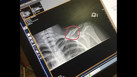 I Broke My Collarbone And Had To Get Surgery Youtube