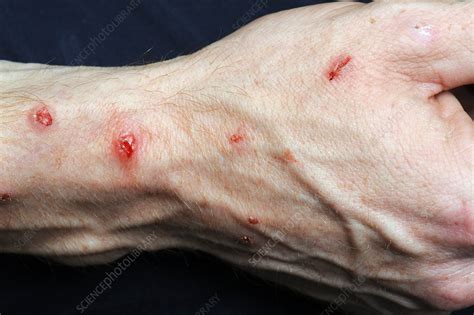 Infected Self Inflicted Skin Lesions Stock Image C0197579