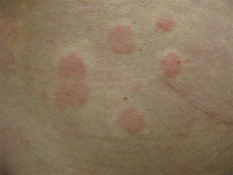 Urticaria