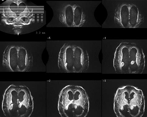 Neonatal Neurosonography European Journal Of Radiology