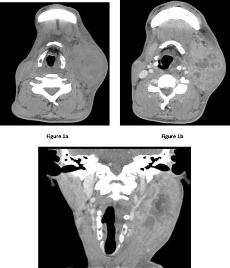 Figure 1 From Ct Imaging Features In Pyomyositis Of Sternocleidomastoid