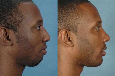 Non Surgical Chin Augmentation Champaign Chin Fillers Il