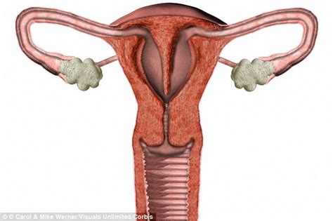 Doctors Explain How They Will Cut Risk Of Ovarian Cancer Daily Mail
