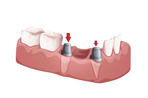 What Are Mini Dental Implants Benefits Procedure And Cost