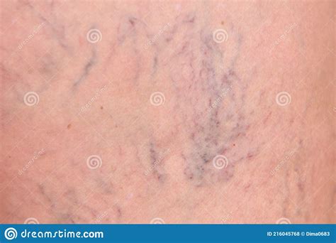 Varicose Veins On Female Legs In The Hips Sipder Veins Thigh Close Up