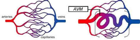 Arteriovenous Malformation Avm Childrens Wisconsin