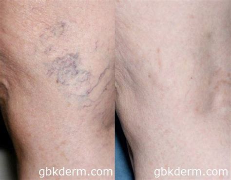 Before And After Sclerotherapy For Spider Veins Vein Removal