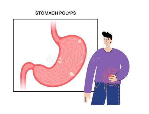 Stomach Polyp Disease Stock Vector Illustration Of Infection 250772052