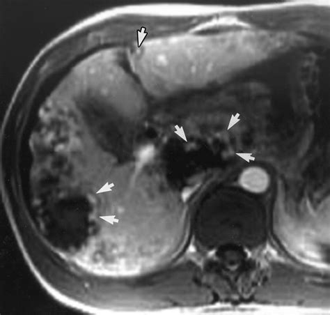 Hepatic Hemangioma Atypical Appearances On Ct Mr Imaging And