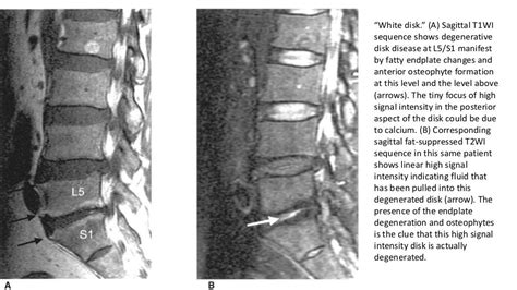 Imaging Of Lumbar Spondylosis