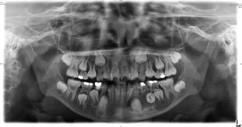 Marsupialization Facilitates Eruption Of Dentigerous Cyst Associated