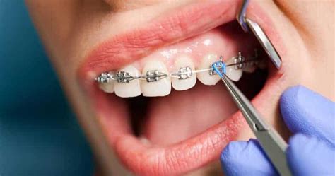 Nhs Braces Everything You Need To Know About Nhs Orthodontics