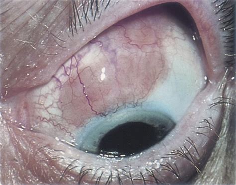 Conjunctival Lymphoma American Academy Of Ophthalmology