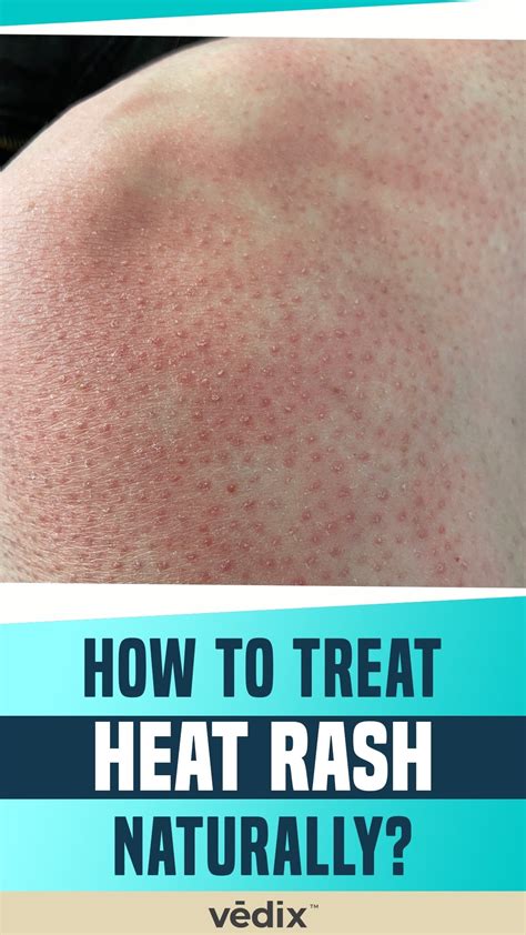 How To Treat Heat Rash Naturally