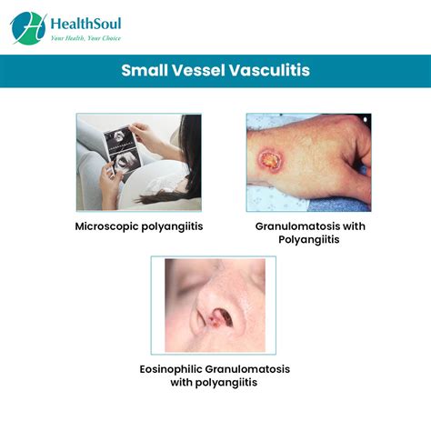 Vasculitis Types