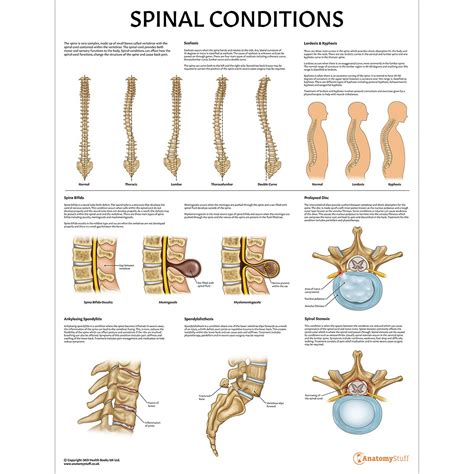 Laminated Spinal Conditions Poster Spine Pathology Chart