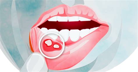 Oral Cancer Symptoms 13 Signs Of Mouth Cancer Healthella