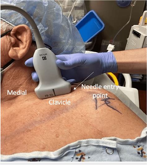 Figure 1 From Comparison Of Supraclavicular Regional Nerve Block Versus