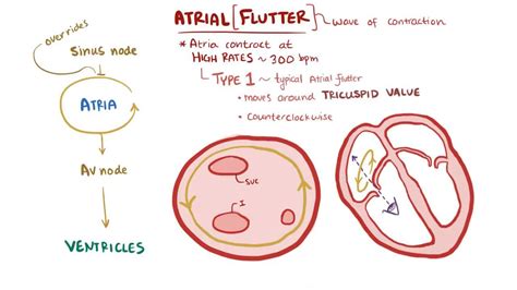 Atrial Flutter Video Anatomy Definition Function Osmosis