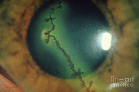 Dendritic Ulcer Herpes Simplex On Cornea Of Eye Photograph By
