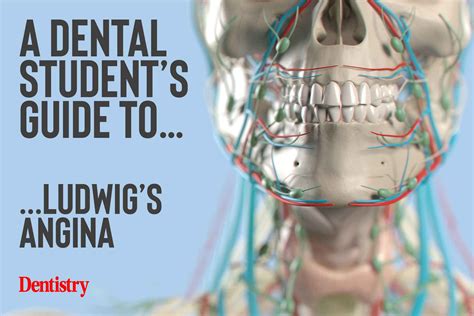 A Dental Students Guide Toludwigs Angina Dentistry