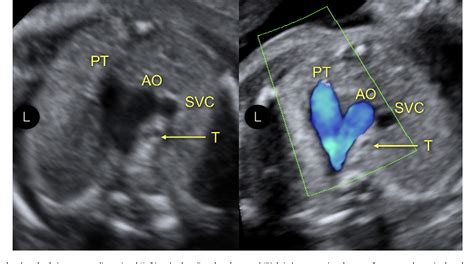 Normal Baby Heart Rate Ultrasound Febabys